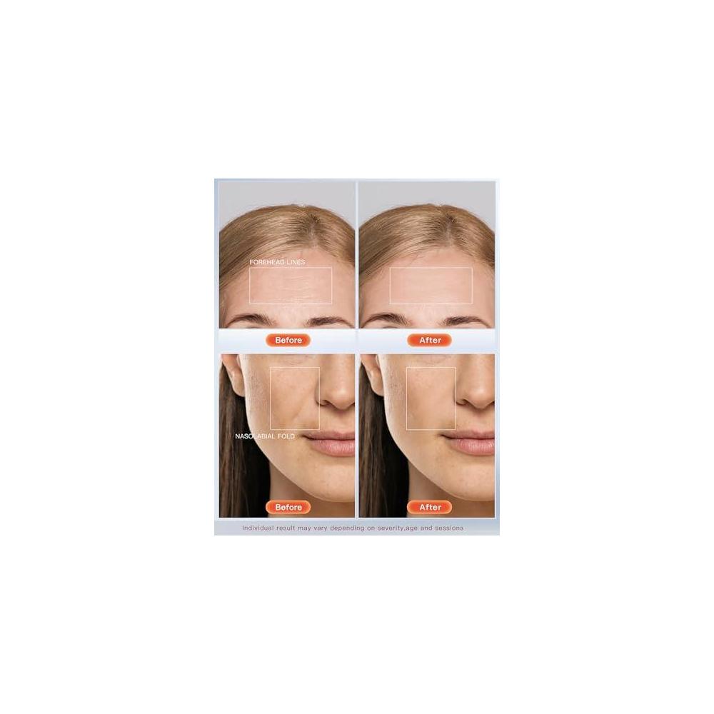 Sistema de terapia de fotones Newkey de luz LED de 7 colores para cuidado facial y máscara de belleza, trata arrugas y acné