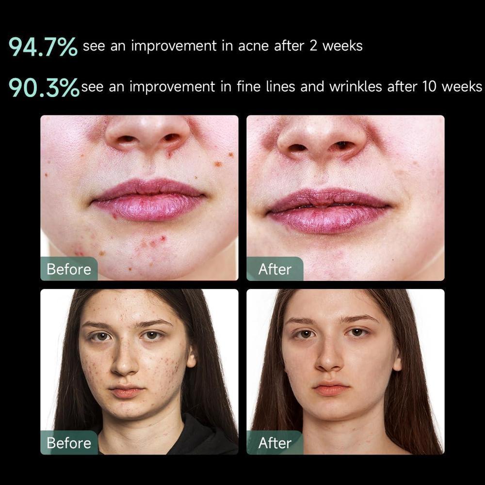 Aphrona Máscara facial LED aprobada por la FDA para reducción de arrugas y eliminación de acné con terapia de luz roja y azul