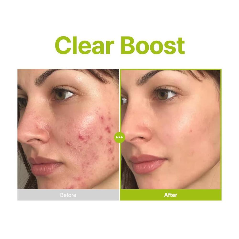 Purito Serum Facial Acido Azelaico 10% Acido Kojico Arbol De Te 30ml