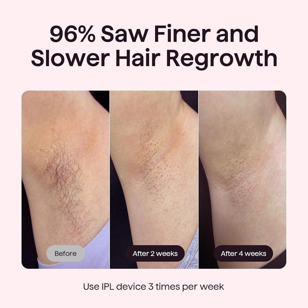 Wavytalk Dispositivo IPL Bare It para cara, cuerpo y bikini de larga duración y sin dolor con enfriamiento de hielo