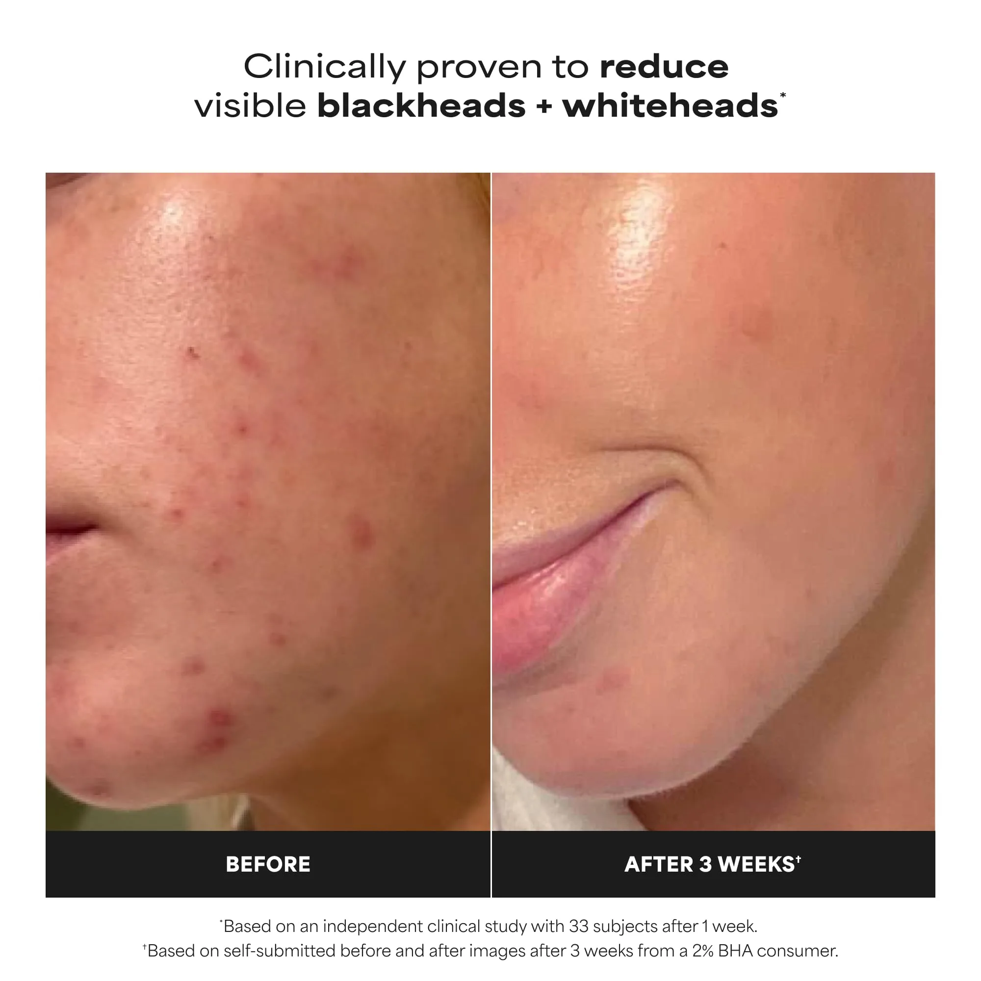 Paula's Choice SKIN PERFECTING 2% BHA Liquid Salicylic Acid Exfoliant-Facial Exfoliant for Blackheads, Enlarged Pores, Wrinkles & Fine Lines