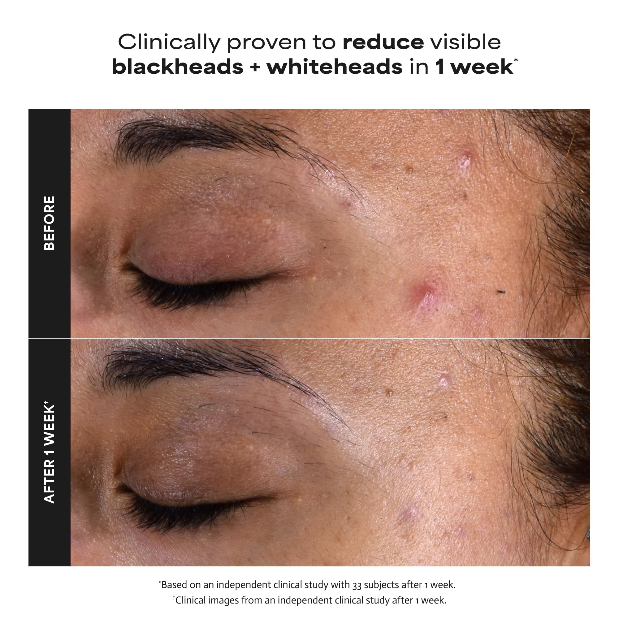 Paula's Choice SKIN PERFECTING 2% BHA Liquid Salicylic Acid Exfoliant-Facial Exfoliant for Blackheads, Enlarged Pores, Wrinkles & Fine Lines